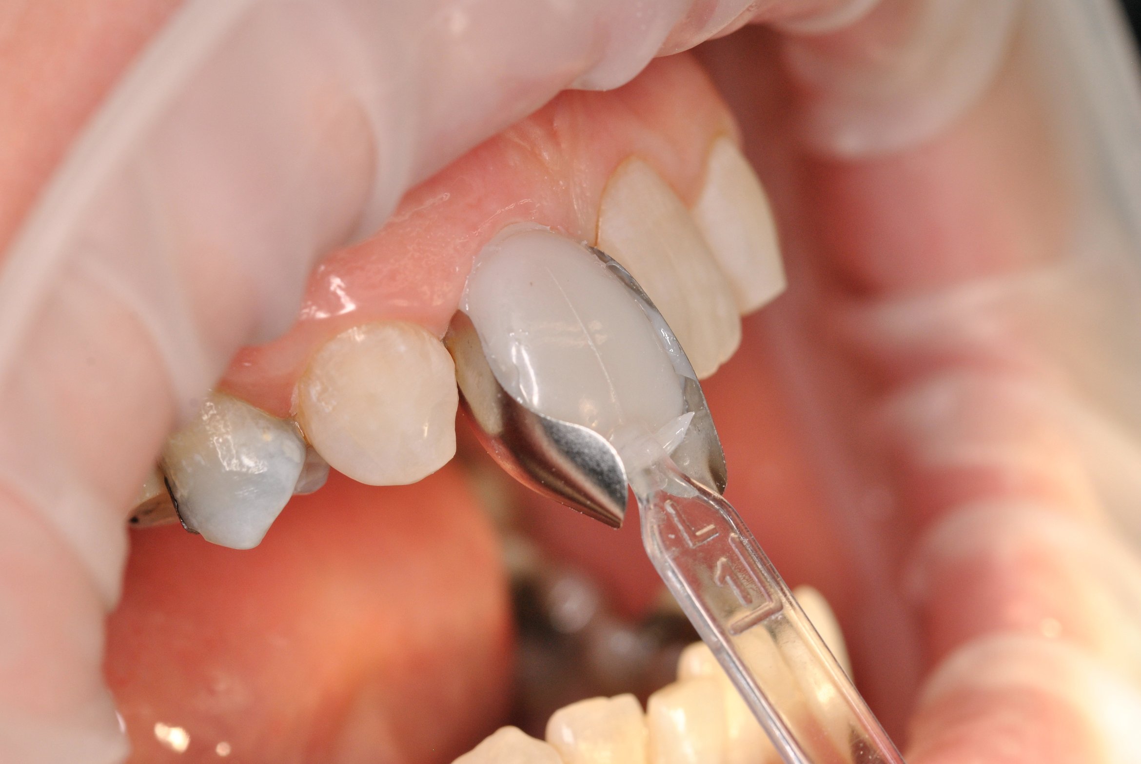 How To Create Easy Direct Composite Veneers Optident